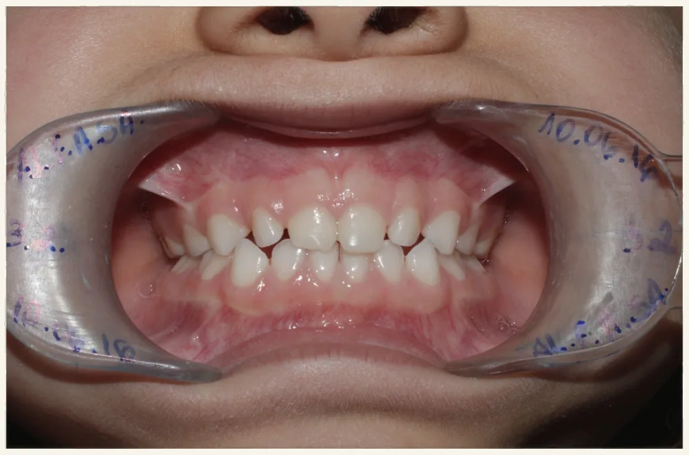 Dentição decídua completa